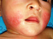 Atopic_DERMATITIS_1_070703.jpg