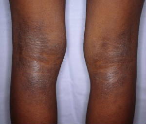 Atopic_Dermatitis_1_070403legs.jpg