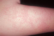 Keratosis_Pilaris_1_031125.jpg