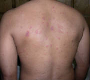 Pityriasis_Rosea_1_051205.jpg