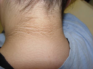 acanthosis_nigricans_1_041130.jpg