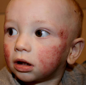 atopic_dermatitis_face_1_051214toddler.jpg