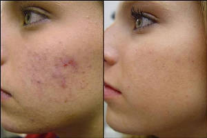 dermabrasionacnescars.jpg