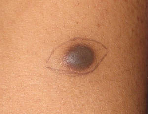 dermatofibroma_1_080212.jpg