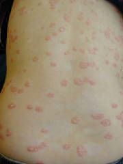 guttatepsoriasis.jpg