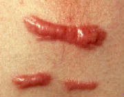 keloids_hypertrophic_scars.jpg