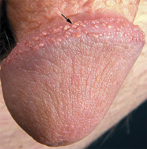 pearlypenilepapules.jpg