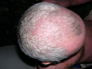 psoriasisscalp.jpg