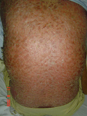 psoriatic_erythroderma_1_051010.jpg