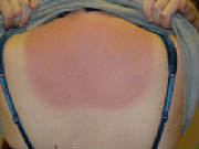 sun_burn_1_030507.jpg