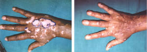 vitiligo.jpg
