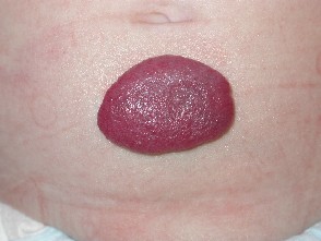 Hemangioma1.jpg