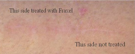LMscarfraxel.JPG