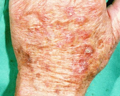 actinickeratosis.jpg