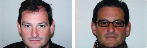 hairtransplantbeforeafter1.jpg