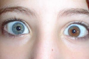 hetrochromiairides.jpg