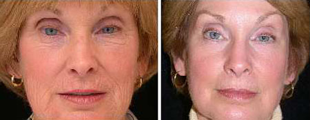 laser-resurfacing-before-and-after2.jpg