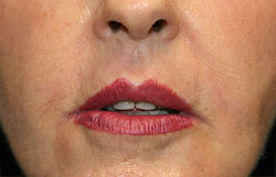 lipafter1.jpg