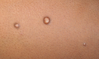 molluscum_contagiosum1.jpg