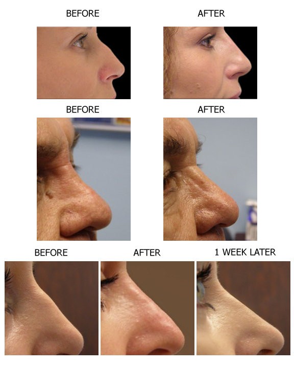 nonsurgicalnosejobtreatment1.jpg