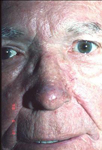 rhinophyma_rosacea_after_150.jpg