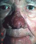 rhinophyma_rosacea_before2_150.jpg