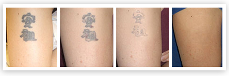 tattooremovalbeforemiddleafter.jpg