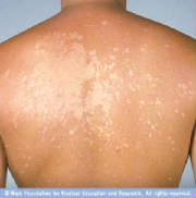 tineaversicolor.jpg.w180h182.jpg