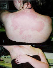 urticaria_1_050512.jpg.w180h232.jpg