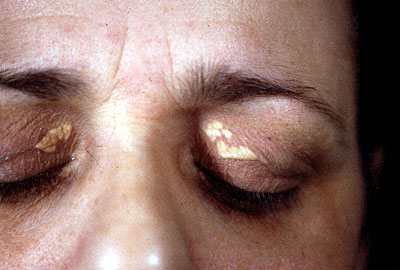 xanthelasma.jpg